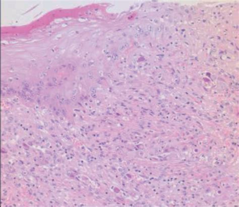 Opportunistic CMV infection in the digestive tract. The tongue is... | Download Scientific Diagram