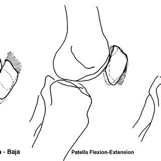 Example of a patient with squinting patella due to excess of tibial... | Download Scientific Diagram