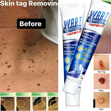 Wart Mole Removal Cream Antibacterial Skin Tag Remover Body Treatment ...