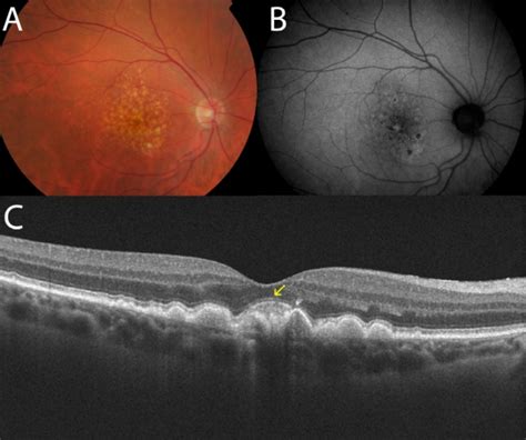 Macular Degeneration Oct