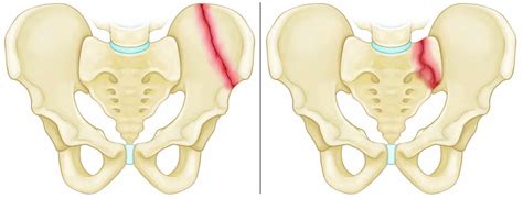 Pelvic fracture types, causes, signs, symptoms, diagnosis & treatment