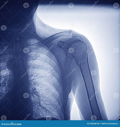 X-ray Of The Human Shoulder Joint. Fracture In The Neck Of The Right Humerus. Osteoarthritis Of ...