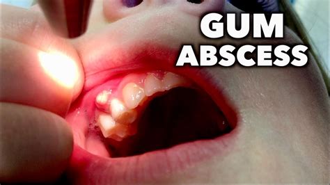 GUM ABSCESS | Dr. Paul - Dental Clinic