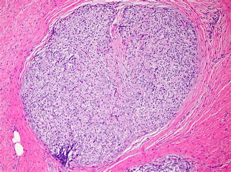 Erythema Elevatum Diutinum Histology