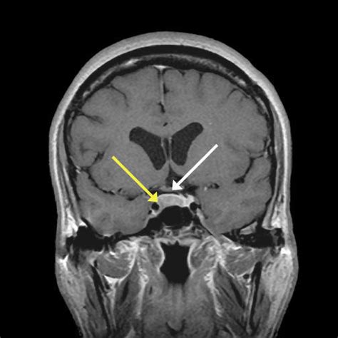 MRI Studies of the Patient's Pituitary GlandMRI of the | Open-i