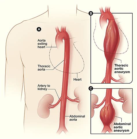 รายการ 98+ ภาพ abdominal aortic aneurysm อาการ ใหม่ที่สุด - VTTN