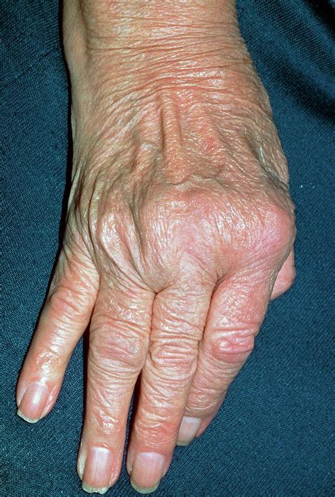 Rheumatoid Arthritis Of Hand With Ulnar Deviation Photograph by Science Photo Library