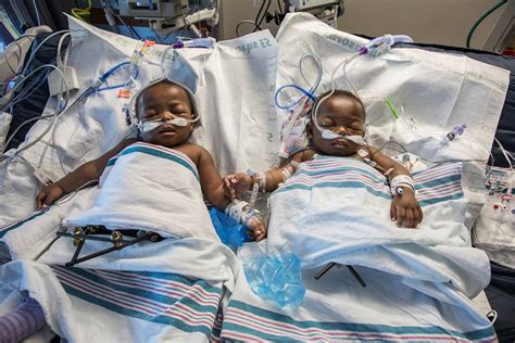 Conjoined Twins From Nigeria Separated At Tennessee Hospital - Medical Design and Outsourcing