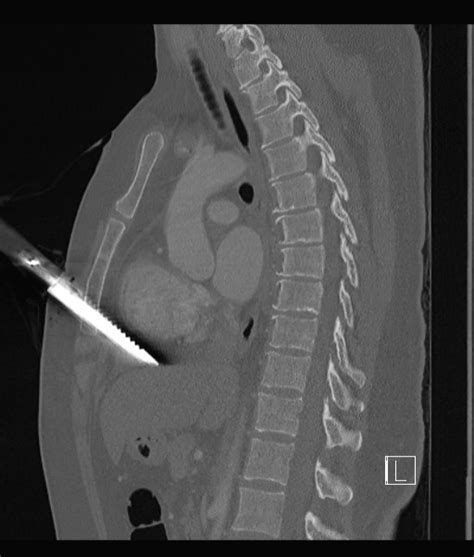 penetrating chest trauma Archives - Charlie's ED