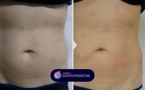 Cryolipolysis - What is it | Cosmetic Derma Medicine