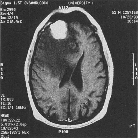 -Temporolimbic tumor. Patient 6 was manic for 3 months, and her age ...