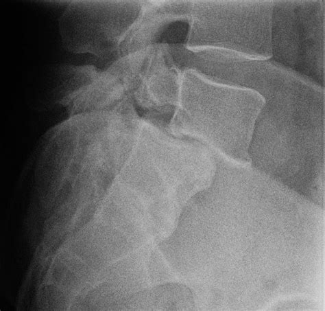 Cervical retrolisthesis trauma - writingquizzes.web.fc2.com