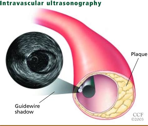 MEDICINE: Utility of intravascular ultrasound in peripheral ...