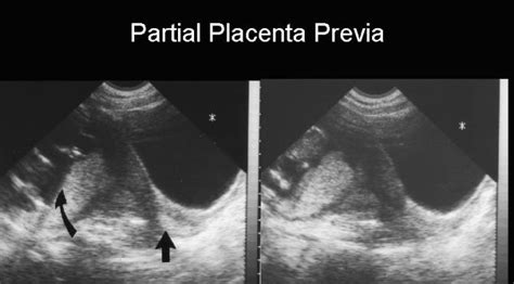 Classification of Placenta Previa