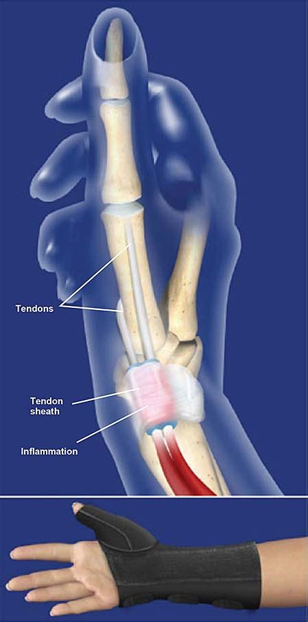 De Quervain S Tenosynovitis Causes Signs Remedy All About Fitness | The Best Porn Website