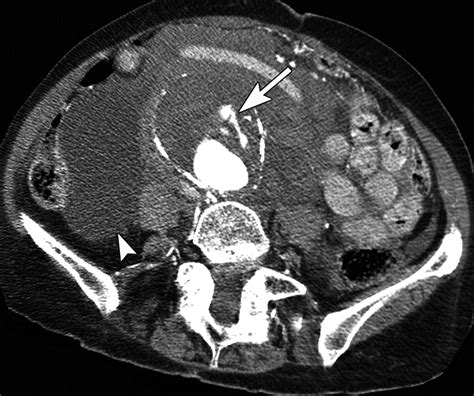 Spectrum of CT Findings in Rupture and Impending Rupture of Abdominal Aortic Aneurysms ...