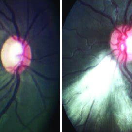 Fundus photography showing a normal right eye and left eye with... | Download Scientific Diagram