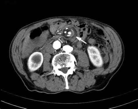 The whirlpool sign: midgut volvulus | Emergency Medicine Journal