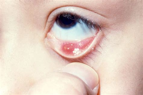 Chalazion - American Academy of Ophthalmology