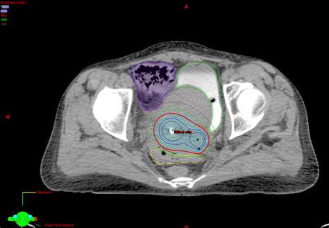 Cureus | Grade 3 Radiation Recall Sigmoiditis after Treatment for Locally Advanced Cervical ...