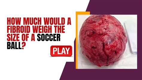 How Much Would a Fibroid Weigh the Size of a Soccer Ball? - YouTube