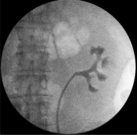 Retrograde Pyelogram of left sided collecting system | Download ...