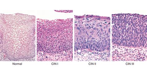 Cervical Intraepithelial Neoplasia Cin | Free Download Nude Photo Gallery