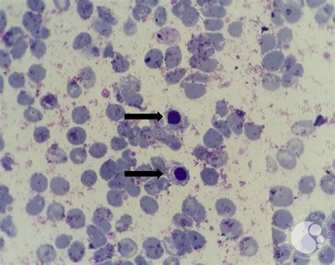 Presence of nucleated RBCs (NRBCs) in peripheral blood smear 3