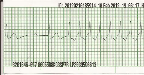 Float Nurse: EKG Rhythm Strip Quiz 1