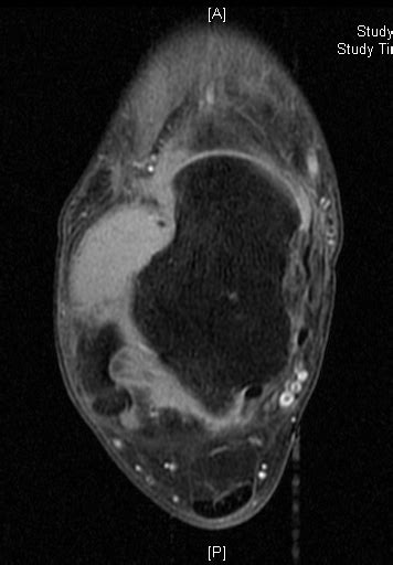 Synovial Sarcoma: Soft Tissue Sarcoma