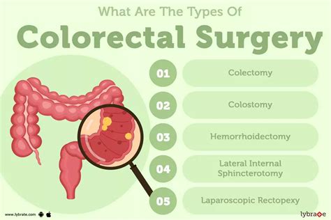 Colorectal Surgery: Purpose, Procedure, and Benefits and Side Effects