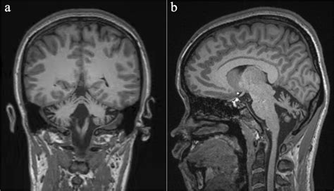 Brain magnetic resonance imaging (MRI) confirmed the presence of... | Download Scientific Diagram