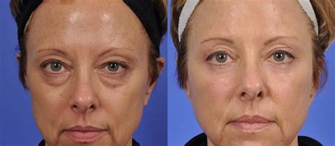 Laser Resurfacing - Dr. Harinder S. Chahal MD