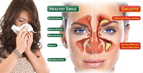 Acute Sinusitis | Getcured Apothecary Pvt Ltd