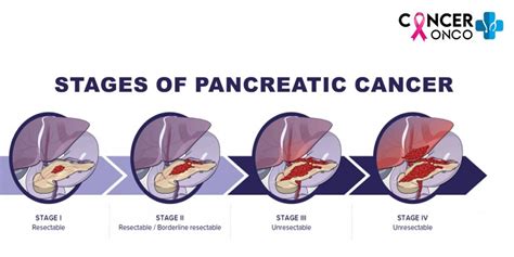 Pancreatic Cancer Treatment and Its 5 Stages