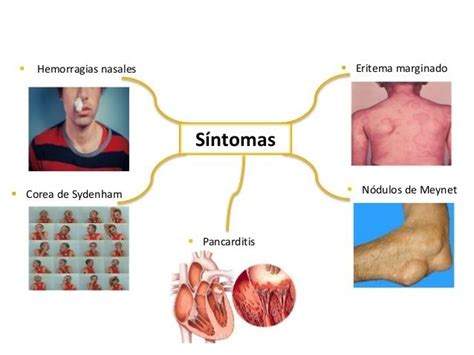 FIEBRE REUMATICA | Slide Set