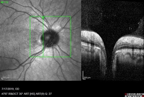 Vertical OCT Scan Through Right Optic Disc Pit - Retina Image Bank