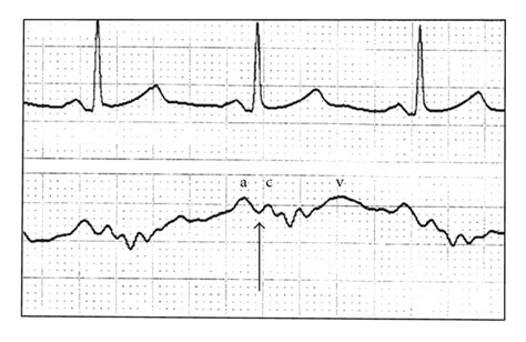 A typical CVP waveform (lower tracing) and accompanying... | Download Scientific Diagram