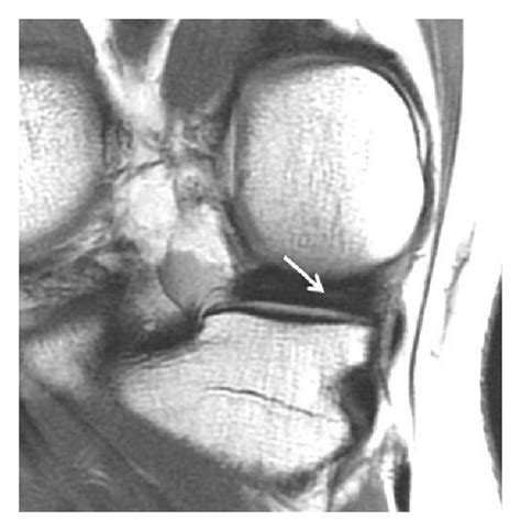 Oblique tears are a type of radial tear: (a) Coronal T2 FSE Fat Sat... | Download Scientific Diagram