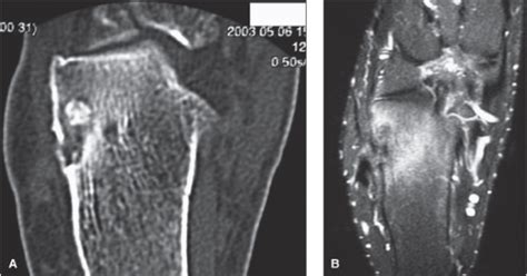 Calcaneal Spurs | Radiology Key