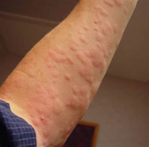 Relief From Hives (Urticaria) and Eczema Rashes In Under One Minute ...