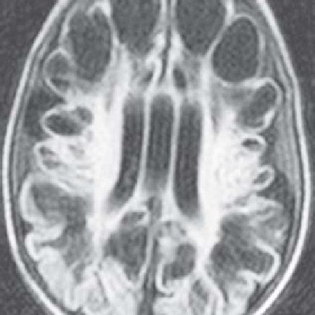 Axial FLAIR image showing multiple subcortical cysts of CSF signal... | Download Scientific Diagram