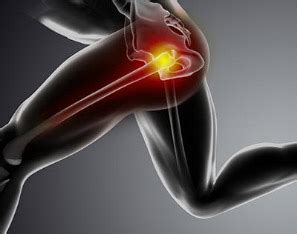 Proximal Hamstring Tendon Tears – A Common Cause of Hip Pain