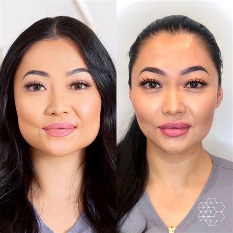 Facial Slimming Vancouver, BC | Non Surgical Jawline Treatment