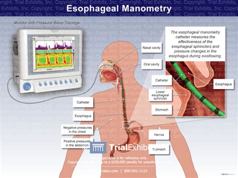 Esophageal Manometry - TrialQuest Inc.