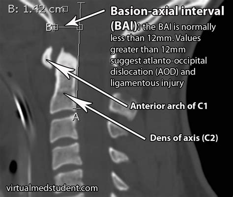 VirtualMedStudent.com || Atlanto-Occipital Dislocations | Dislocation ...