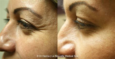 Botox, Dysport and Xeomin Before and After Photos by Dr. Hanna | Ventura