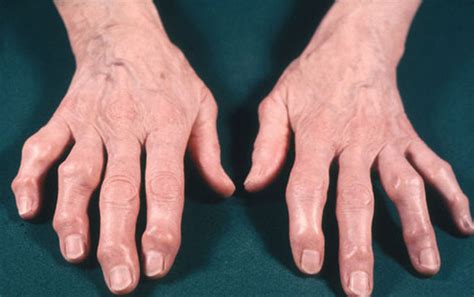 A Patient's Guide to Osteoarthritis of the Hand - Hand and Upper Limb Clinic