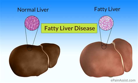 Herbal Remedies and medicines for Fatty Liver - TheAyurveda