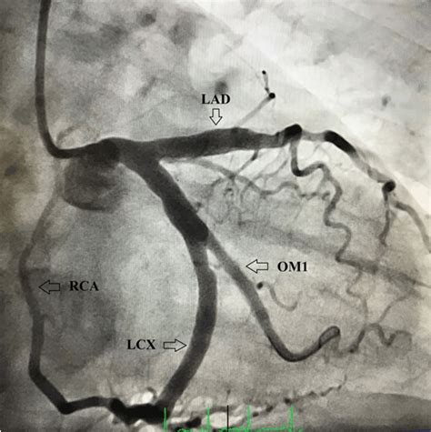 Coronary artery conundrum: A single coronary artery with origin of the right coronary artery ...